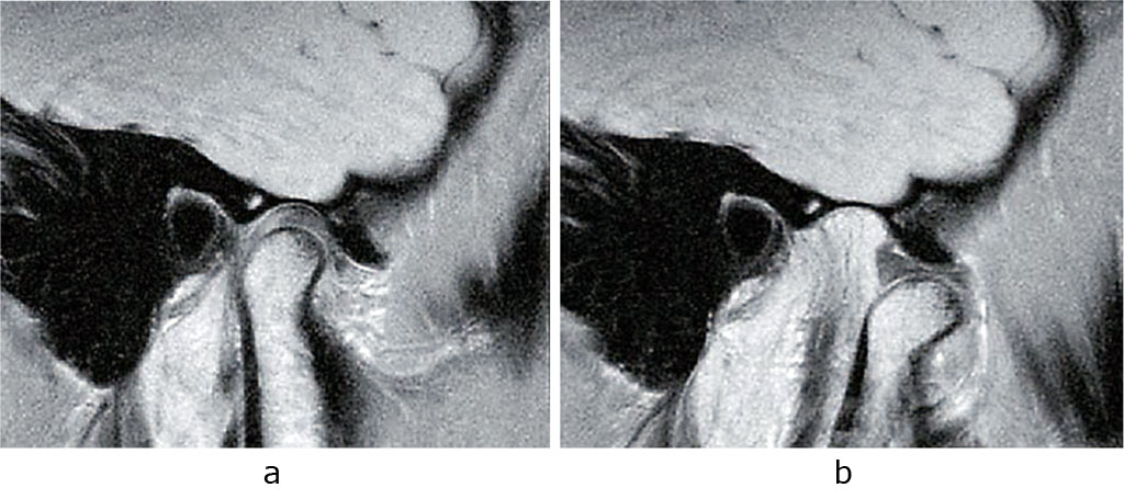 Fig. 3. TMJ MRI in the oblique sagittal projection; mouth closed (a) and open (b).