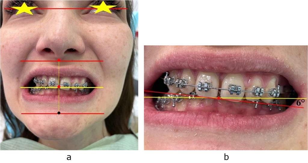 Figure 5. Occlusal relationships (a) and the occlusal plane divergence angle (b) in patient V., 23 y.o., featuring dentoalveolar transversal divergent occlusion
