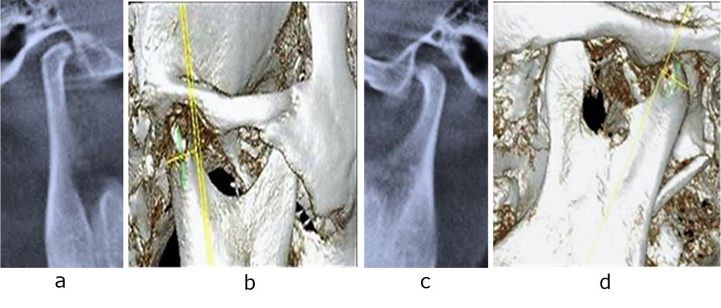 Fig. 6. Patient V., CBCT, right (a, b) and left (c, d) TMJ, mouth closed; prior to orthodontic treatment