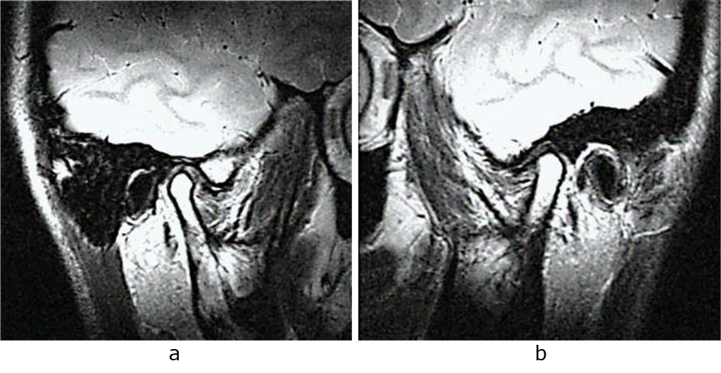 Fig. 7. Patient V., MRI, right (a) and left (b) TMJ, oblique sagittal projection; prior to orthodontic treatment