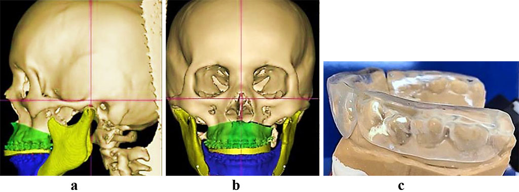 Fig. 9. Patient V., CBCT digital model and 3D rendering, profile (a) and full face (b) with a distracting splint. Distracting splint positioner on lower jaw cast model (c)