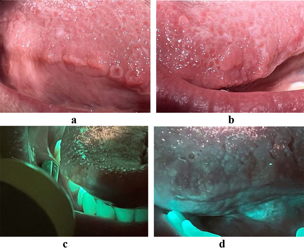 Fig. 1. a, b - papillomatosis of the lateral surface of the tongue