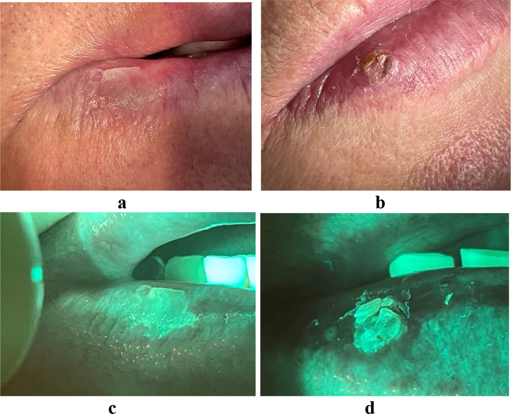 Fig. 2. a, c - hyperkeratosis of the red border of the lower lip