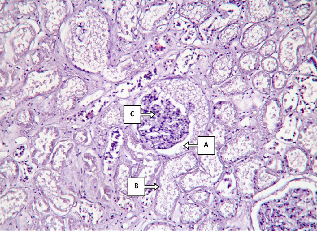 Fig.2. Histological changes in kidney structure in a 2-month antimony intoxication. Description in the text. Hematoxylin-eosin staining, 80x200x400