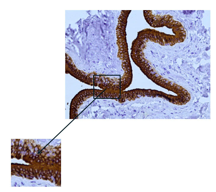 Fig. 9 The excretory duct of the salivary gland. Indirect immunoperoxidase method with antibodies to CK7, x 200. Pronounced expression of cytokeratin 7 (CK7) in the duct epithelium.