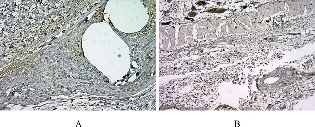Figure 1. 14 days after implantation, a pronounced lymphoplasmacytic infiltration was noted in the first group. There are many CD3+ cells in this zone, about >60% of the inflammatory infiltrate around the voids – the locations of polypropylene monofilaments (A). In the second comparison group with the use of a bioimplant, we noted a weaker CD3 staining, which indicated a moderate inflammatory response (B). (X100).
