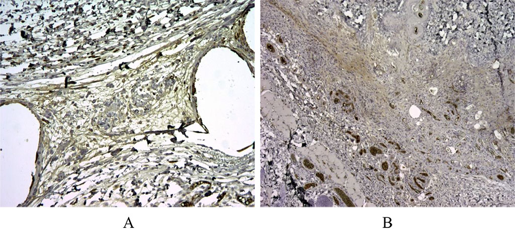 Figure 3. 30 days after implantation. When studying Bcl-2, the regulator of apoptosis, in the first group, specific staining was noted around the voids – the sites of implantation of the synthetic graft, as well as background staining on the vessels for Bcl-2+ (A). In the second group, specific Bcl-2+ staining was not noted (B). X100.