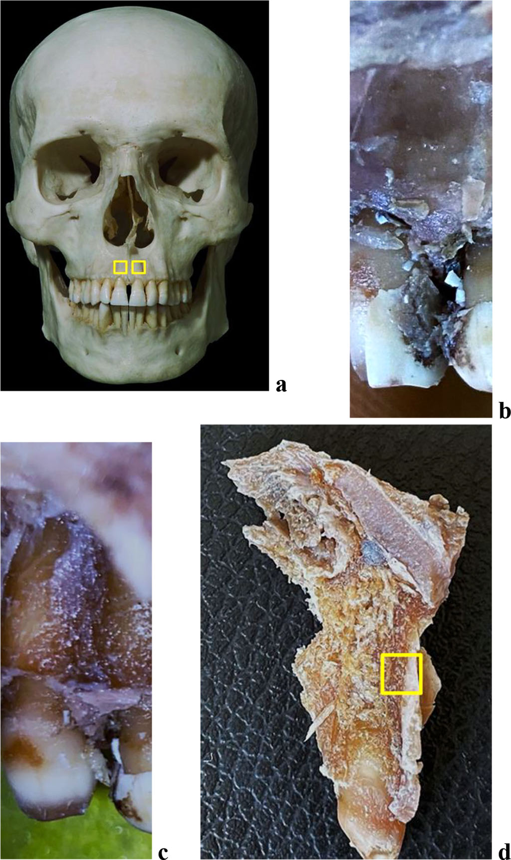 Figure 1. Bone biopsy specimen from the frontal alveolar process of the maxilla with preserved dentition: a – areas for taking bone preparations on the skull; anatomical preparation before (b) and after (c) separation of the muco-periosteal flap in the area of 21 teeth; d – area for taking a bone preparation on the maxillary medial incisor segment of the maxilla (21 teeth).