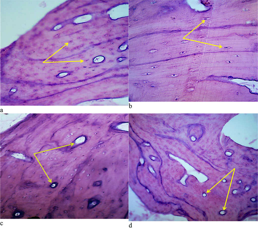 Figure 11. Bone biopsy from the frontal part of the maxillary alveolar process with intact dentition: a – microarchitectonics of the maxillary alveolar process in the projection of the 11th tooth (×200, hematoxylin-eosin staining, osteocytes are indicated by arrows); b – microarchitectonics of the maxillary alveolar process in the projection of the 21st tooth (×800, hematoxylin-eosin staining, arrows indicate osteocytes); b – angioarchitectonics of the maxillary alveolar process in the projection of the 11th tooth (×200, hematoxylin-eosin stain, arrows indicate blood vessels); d – angioarchitectonics of the maxillary alveolar process in the projection of the 21st tooth (×200, hematoxylin-eosin staining, blood vessels are indicated by arrows