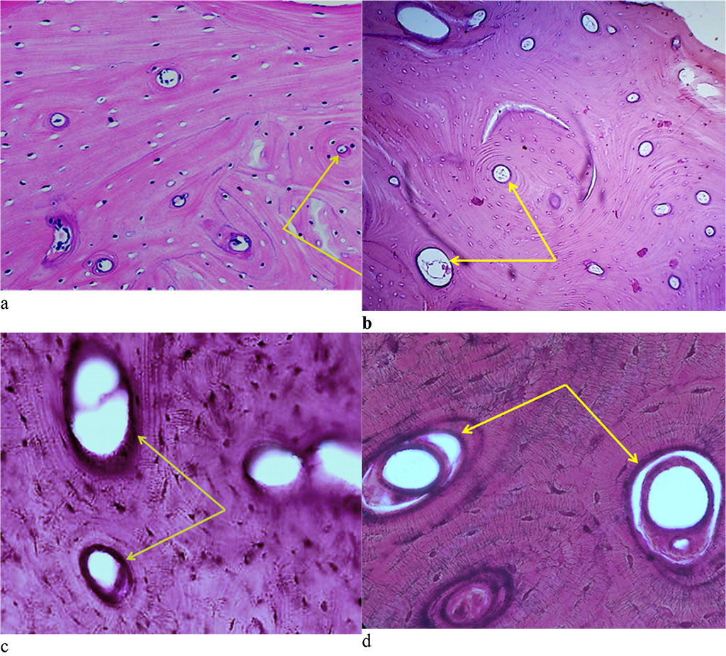 Figure 12. Bone biopsy from the distal part of the maxillary alveolar process with preserved dentition: a – microarchitectonics of the maxillary alveolar process in the projection of the 16th tooth (×100, hematoxylin-eosin staining, the arrows indicate the Haversian canals); b – microarchitectonics of the maxillary alveolar process in the projection of the 26th tooth (×200, hematoxylin-eosin staining, arrows indicate the Haversian canals); c – microarchitectonics of the maxillary alveolar process in the projection of the 16th tooth (×800, hematoxylin-eosin staining, arrows indicate the Haversian canals); d – microarchitectonics of the maxillary alveolar process in the projection of the 26th tooth (×1000, hematoxylin-eosin color, arrows indicate the Haversian canals).