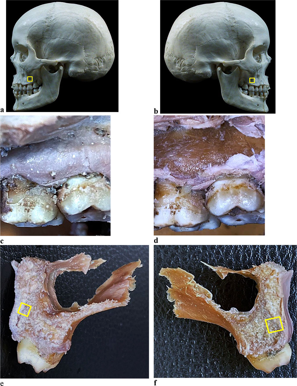 Figure 2. Bone biopsy specimen from the distal alveolar process of the maxilla with preserved dentition: a, b - areas for taking bone preparations on the skull; anatomical preparation before (c) and after (d) separation of the muco-periosteal flap in the area of the 26th tooth; areas for taking a bone preparation on the maxillary first molar segment (e - 16 tooth, f - 26 tooth).