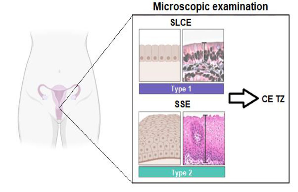 Figure 1. Scheme of the cervical epithelium. Note: SSE - stratified squamous epithelium of the exocervix; CE TZ - columnar epithelium of the transformation zone; SLCE - single-layered cylindrical epithelium of the endocervix