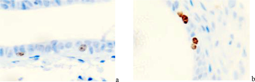 Figure 2. A 63-year-old woman. Localization of Ki67 gene protein in the structures of the cervical mucosa in normal postmenopause. Immunohistochemistry with hematoxylin dyeing. Microphoto. Eq. x400