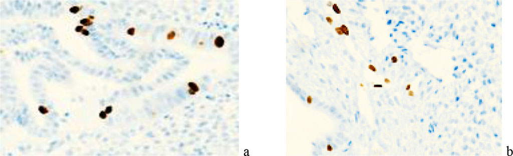 Figure 3. Localization of Ki67 gene protein in the structures of the cervical mucosa in the presence of polyps in the cervical mucosa. Microphoto. Immunohistochemistry. Eq. x200