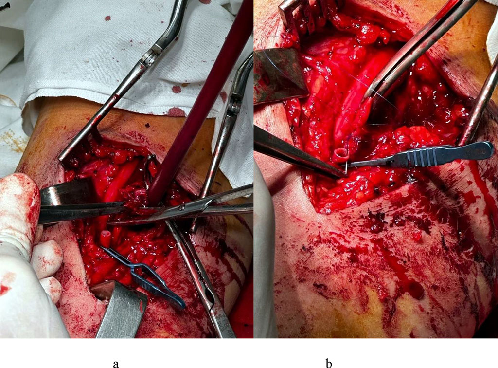 Figure 2. Aneurysmectomy (a), mobilization and endarterectomy of the brachial artery for prosthetic repair.