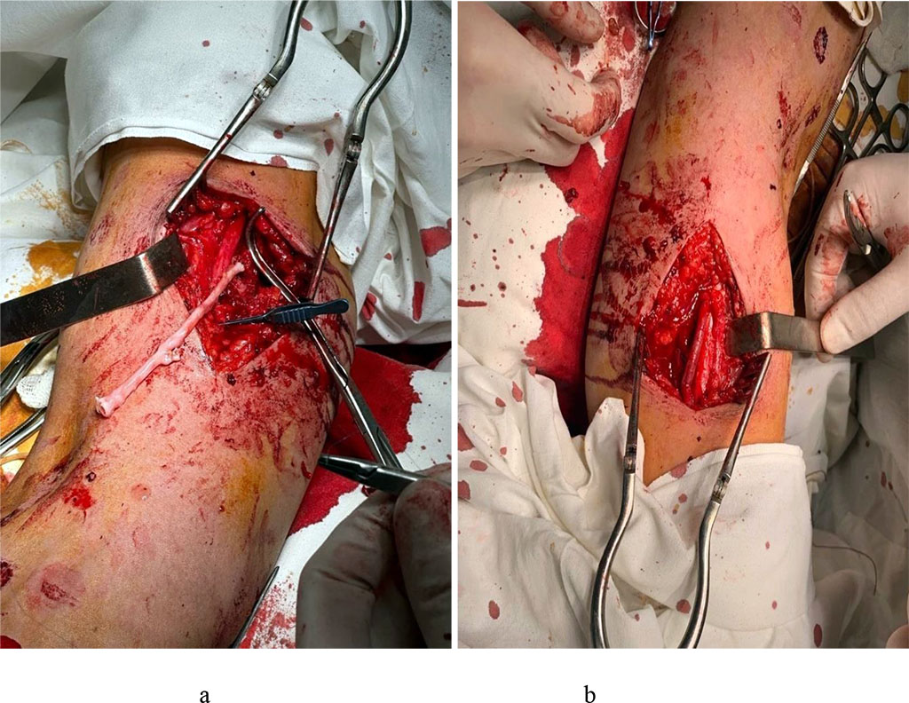 Figure 3. Autovenous prosthetic repair (a). The final appearance of the surgical site – blood flow is restored (b).