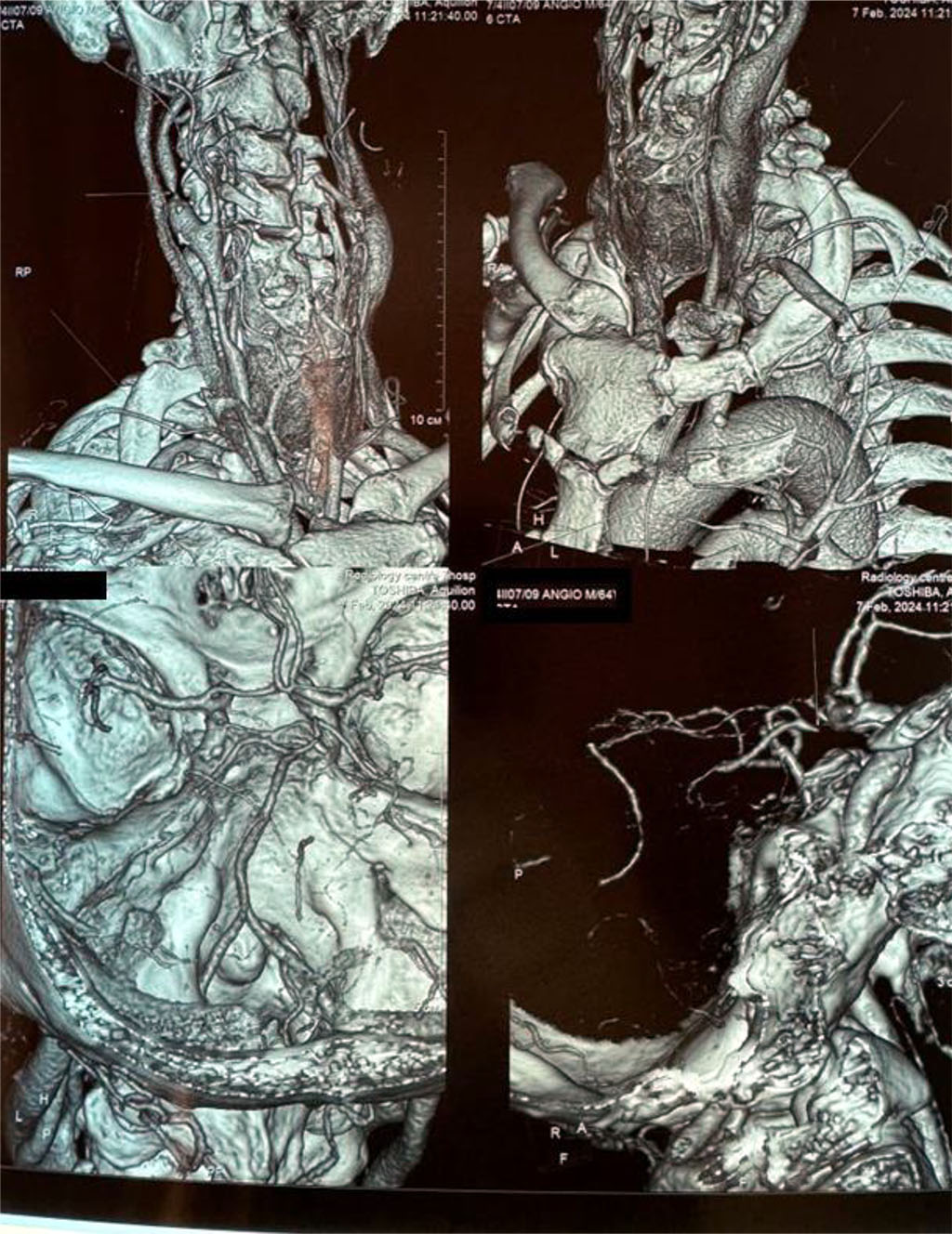 Figure 2. CT angiography (3D reconstruction) in a patient with 85% stenosis of the right external carotid artery and 90% of the internal carotid artery 