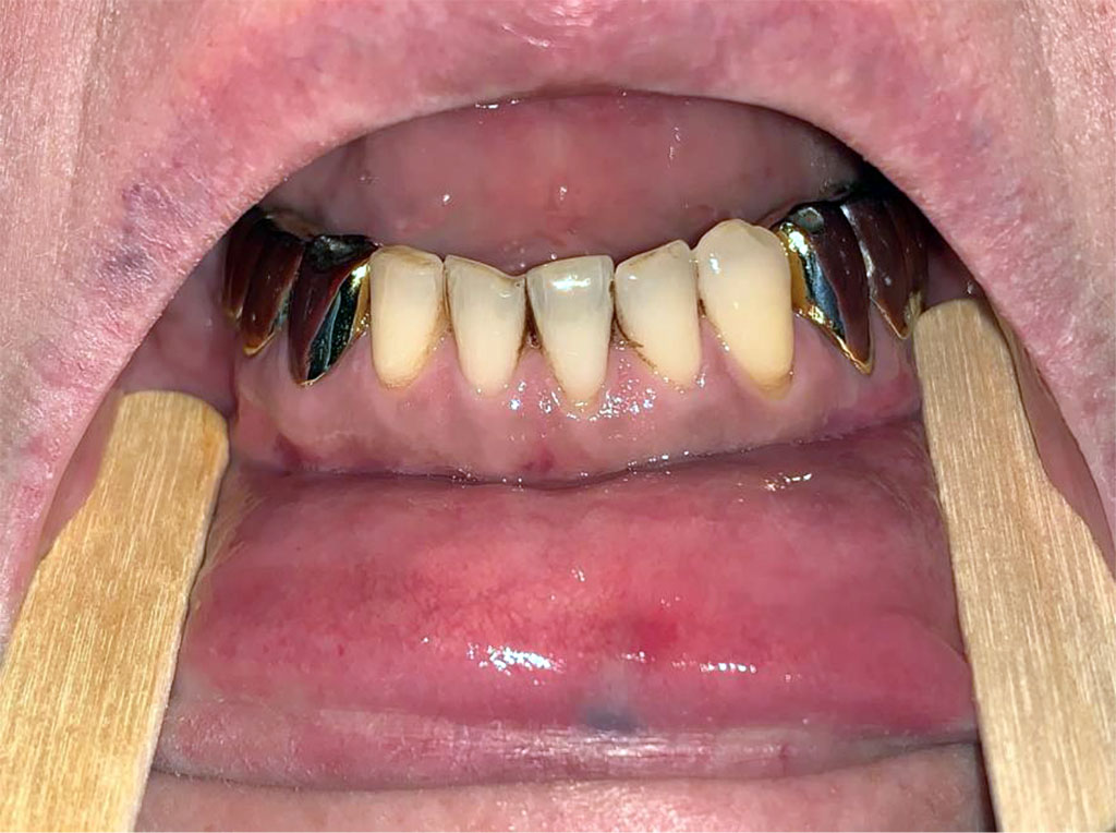 Figure 2. A patient with the lentigo in the lower lip and hyperpigmentation in the mandibular gingiva from the hydroxychloroquine group.