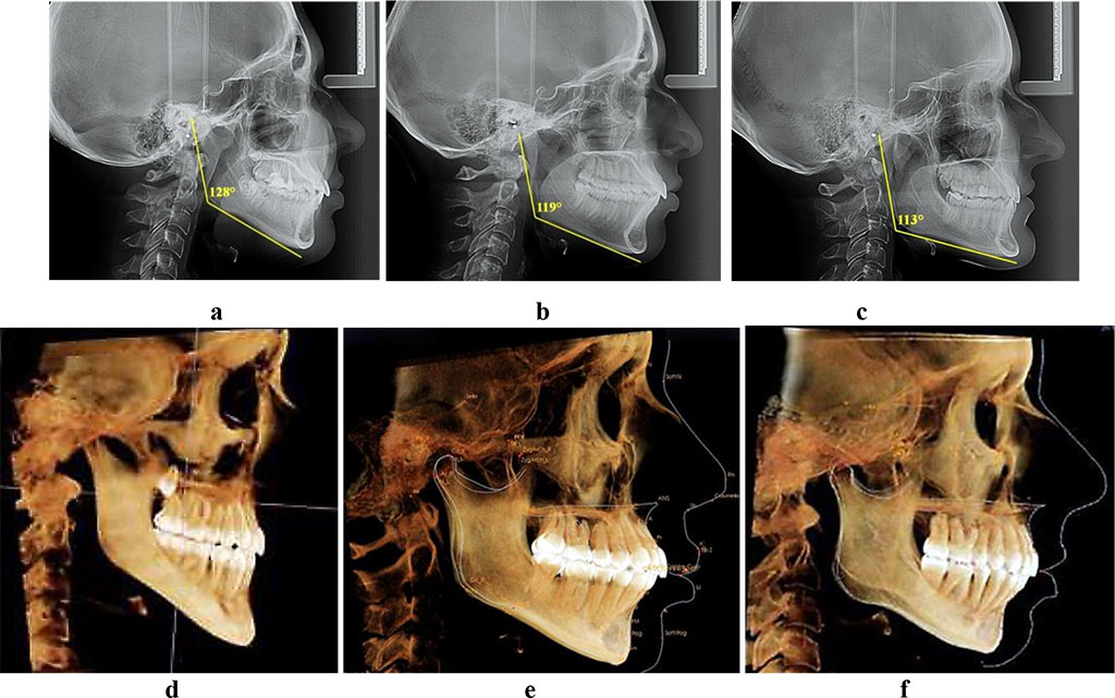 Fig. 1. Teleroentgenograms and computed tomograms, patients with vertical (a, d), neutral (b, е) and horizontal (c, f) type of jaw growth.