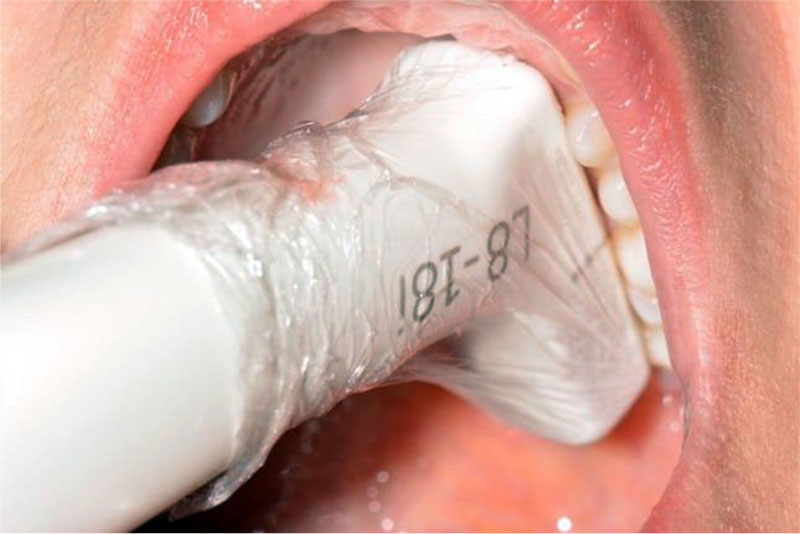 Figure 1. Installation of an intraoperative linear transducer L 8-18i - RS (8-18 MHz) wrapped in one layer of cling film in the hard palate (RF Patent No. 2722055 dated May 26, 2020).