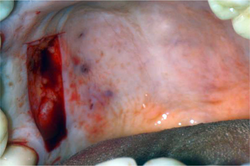 Figure 4. Elevating free gingival autograft from the hard palate.