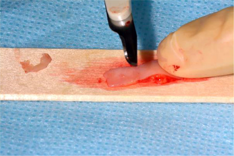 Figure 5. Obtaining a connective tissue subepithelial autograft by deepithelialization.