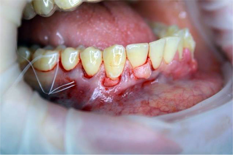 Figure 6. A free connective tissue autograft from the hard palate was introduced into the “tunnel bed” using PTFE 5.0 guide sutures (Golnit, Russia)