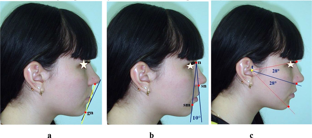 Figure 2 – comparative analysis of the anatomical structures location in relation to Rickett’s and Steiner’s aesthetic facial lines (a), nasal verticals (b) and radial facial lines (c)