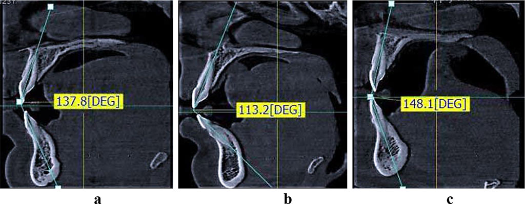 Figure 3 – types of medial incisors location on the CBCT: a – patients of Group 1 (mesotrusive dental arches); b – patients of Group 2 (protrusive dental arches); c - patients of Group 3 (retrusive dental arches).