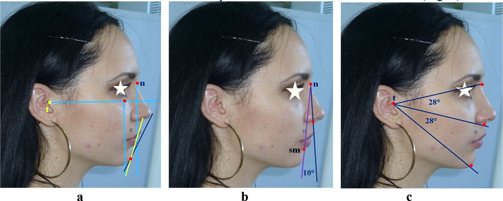 Figure 4 – Specific features of the anatomical structures location in relation to Rickett’s and Steiner’s aesthetic lines (a), nasal verticals (b) and radial lines (c) in case of the mesogenic face type