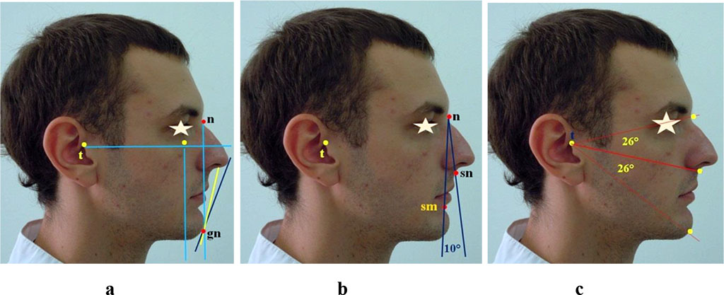 Figure 5 – Specifics of the anatomical structures location in relation to Rickett’s and Steiner’s face aesthetic lines (a), nasal verticals (b) and radial lines (c) in case of the progenic face type