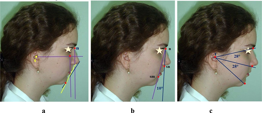 Figure 6 – Specific features of the anatomical structures location in relation to Rickett’s and Steiner’s face aesthetic lines (a), nasal verticals (b) and radial lines (c) in case of the retrogenic type of face