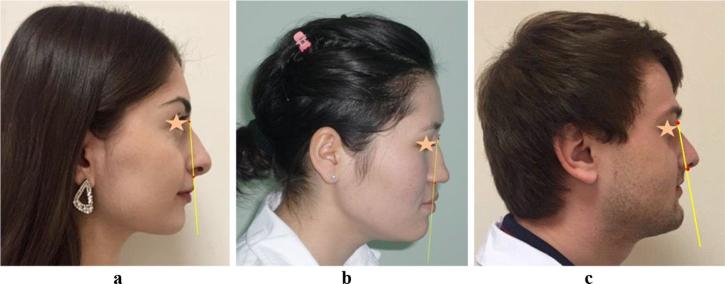 Figure 7 – The lips position in case of mesotrusive (a), protrusive (b) and retrusive types of dental arches (c)