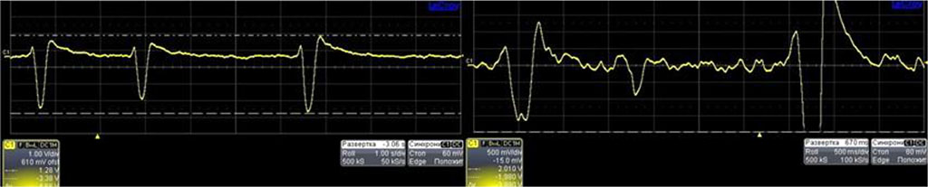 Figure 3. Data from oscilloscope – measured by pressure probe in extrasystolic arrhythmia.