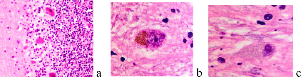 Figure 1 a, b, c - neurons and neuroglia of the brain. A) the norm b, c) degenerating neurons. Stained with hematoxylin and eosin. Increase:а) х100; b-с) х400.