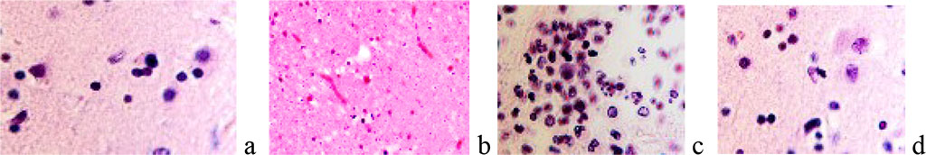 Figure 2. a) neutrophilic macrophage surrounded by neuroglia; b) absence of neurons in the area at the border of the tumor; c, d) apoptosis in the area of ​​malignancy and in the tissue surrounding the tumor. Stained with hematoxylin and eosin. Increase: а) х400; b х100; c, d) х200.