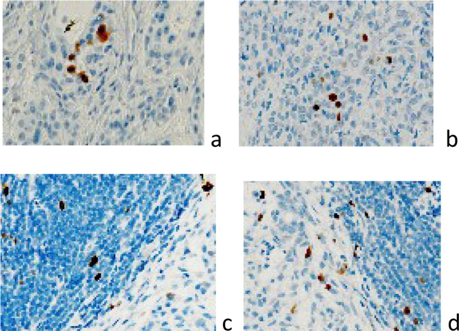 Figure 3 a, b) localization of Ki67 positive cells in the brain tumor structure; c, d) localization of Ki67-positive cells in the tumor structure and at the border with the tumor. Immunohistochemistry for the detection of Ki67-positive cells. Increase: а, b) х400; c, d) х100. 