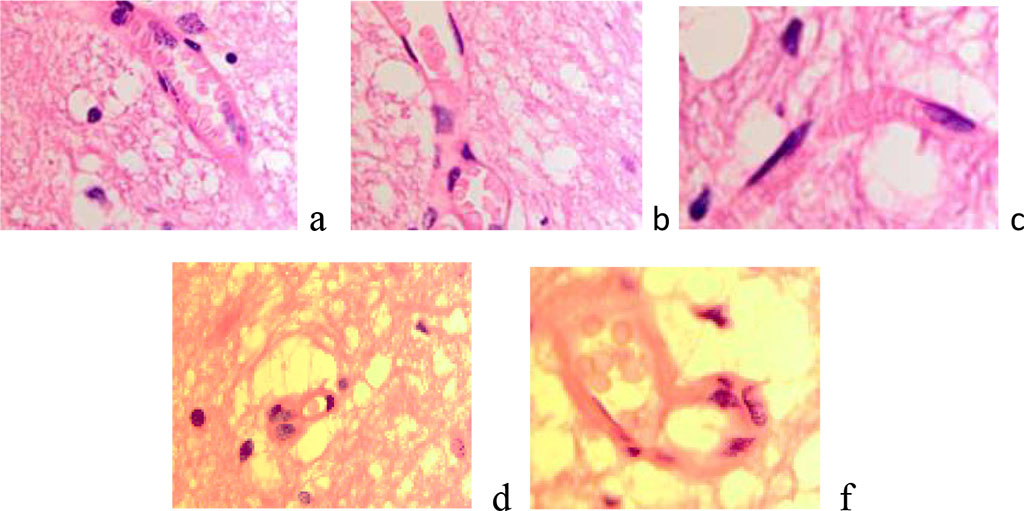 Figure 4 a, b) The blood supply to the brain is normal. C-f) Enlargement of Virchow-Robin spaces in the area at the border with the tumor. Stained with hematoxylin and eosin. Increase х200.
