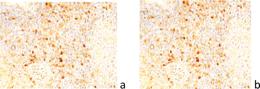 Figure 5 a, b) localization of p53-positive cells in the structure of the tumor and at the border with the tumor. Immunohistochemistry for the detection of p53-positive cells. Increase: а, b) х100. 