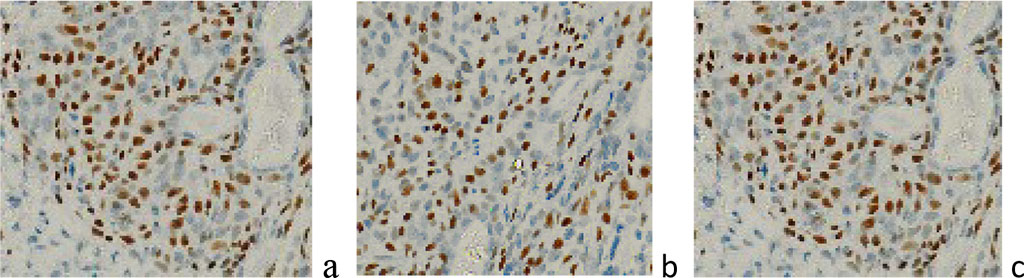 Figure 6 a, b) localization of p63-positive cells in the tumor structure; c) localization of p63-positive cells in the tumor structure and at the border with the tumor of a 45-year-old patient in the area of ​​the right frontal lobe of the brain. Immunohistochemistry for the detection of p63-positive cells. Increase: х400; 