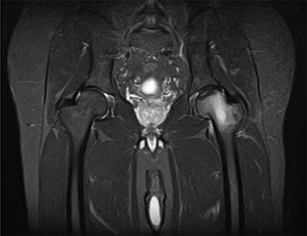 Figure 1. Findings in a 53-year-old man with stage 3 avascular necrosis of the left hip.