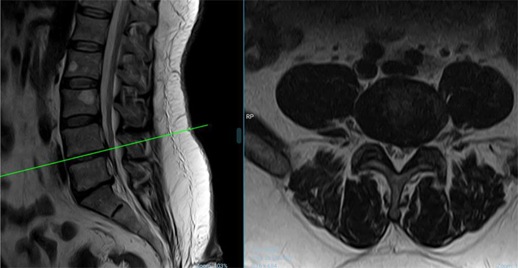 Figure 2. The second patient's lumbar MRI (Sagittal and Axial) picture