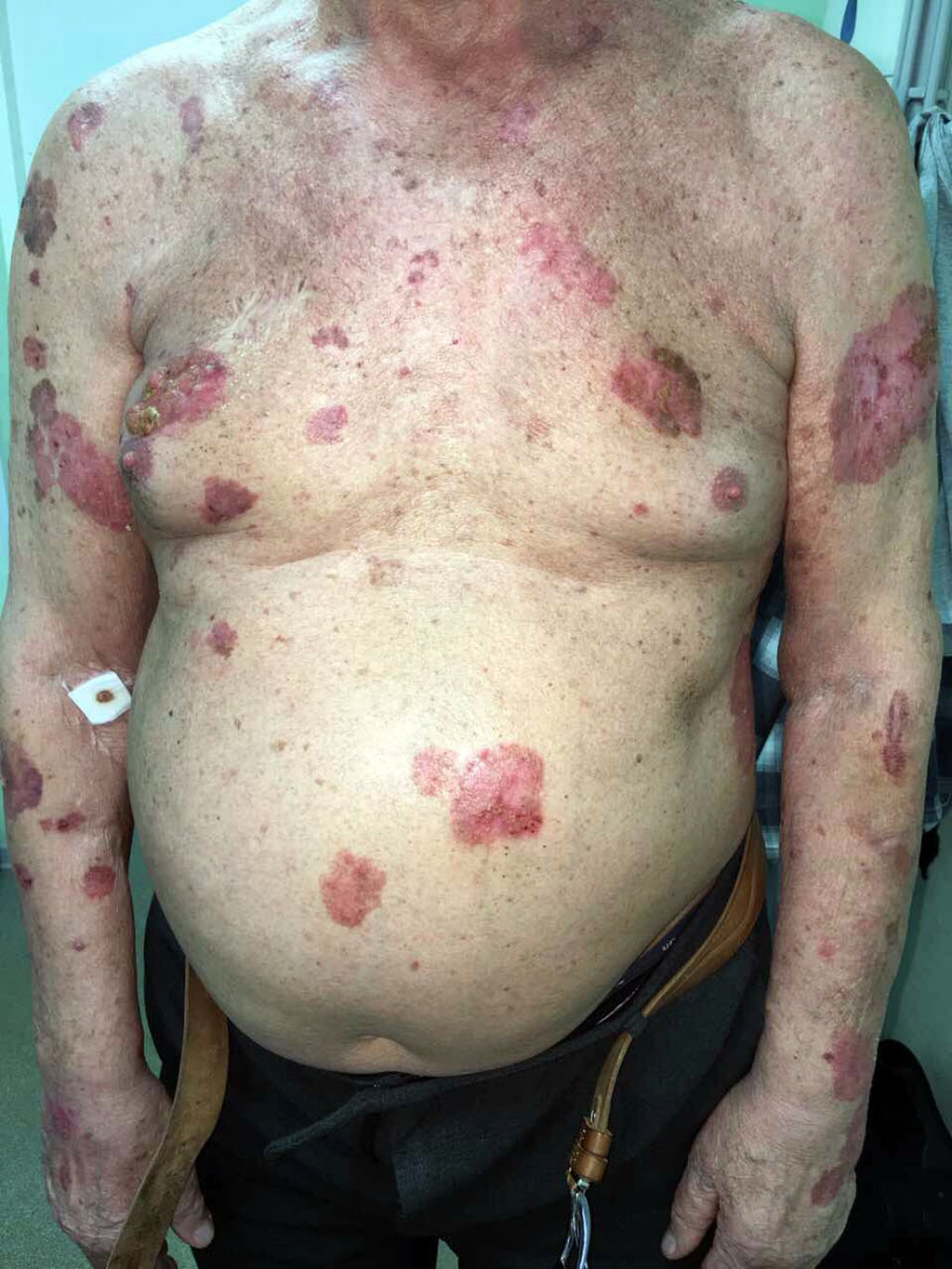 Figure 1. Spots, plaques, nodes on the skin of the upper limbs, chest, abdomen 