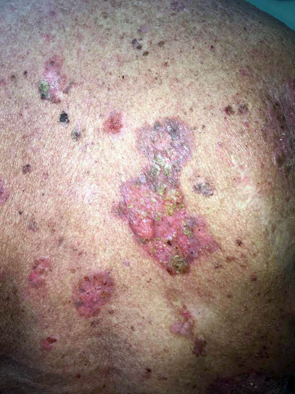 Figure 3. Spots, plaques, nodes on the skin of the back
