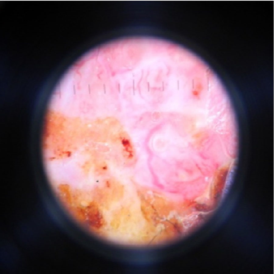 Figure 5. Dermatoscopic picture of basal cell skin cancer in patient C. (Heine Delta 20, eyepiece-10, immersion, non-polarized mode)