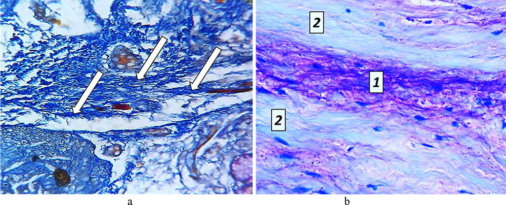 Fig. 17. Pathomorphological changes in the tooth pulp, the main group rats, Day 24 of the experiment: a – accumulation of glycosaminoglycans (×200, Mallory staining); b – metachromasia phenomenon: 1 – areas showing mucoid swelling; 2 − unchanged structure of collagen fibers (×800, Mallory staining).