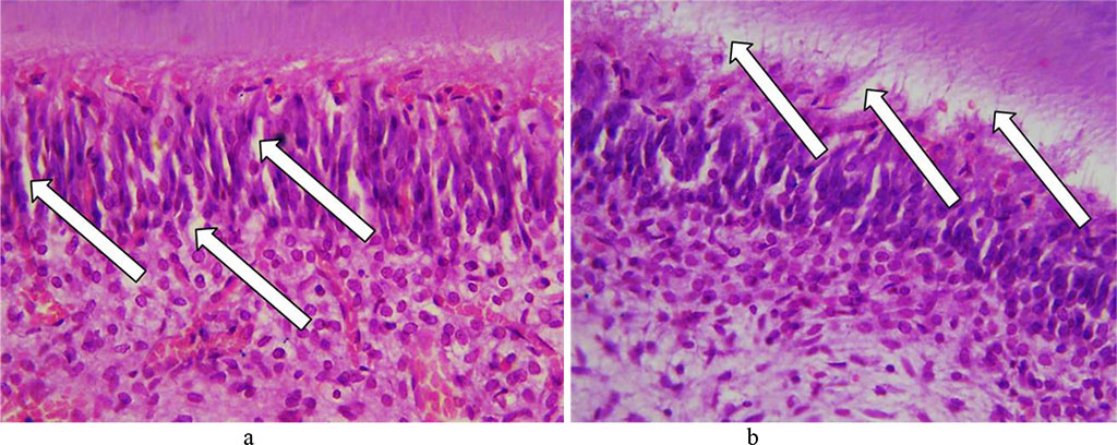 Fig. 21. Pathomorphological changes in the odontoblast layer, the main group rats, Day 32 of the experiment: a – edema in the perivascular spaces and between odontoblasts (×400, hematoxylin-eosin staining); b – accumulation of edematous fluid with odontoblasts getting detached (×400, hematoxylin-eosin staining).