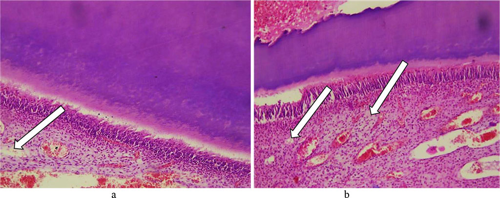 Fig. 22. Pathomorphological changes in the tooth cement, the main group rats, Day 32 of the experiment: a, b – foci of lysis in cellular and non-cellular cement with developing cavities (×200, hematoxylin-eosin staining).