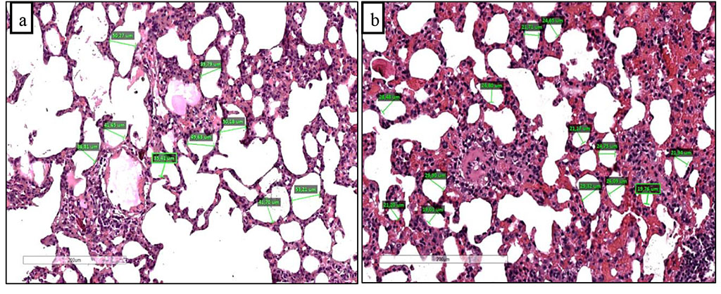 Figure 1. Overstretched and partially damaged alveoli around vessels with edema and perivascular infiltration (a) and thickened interalveolar septa with perivascular edema and infiltration (b) after 60 days of chronic hypoxia with inhalation of natural gas. Staining with hematoxylin and eosin. Zoom. x200.