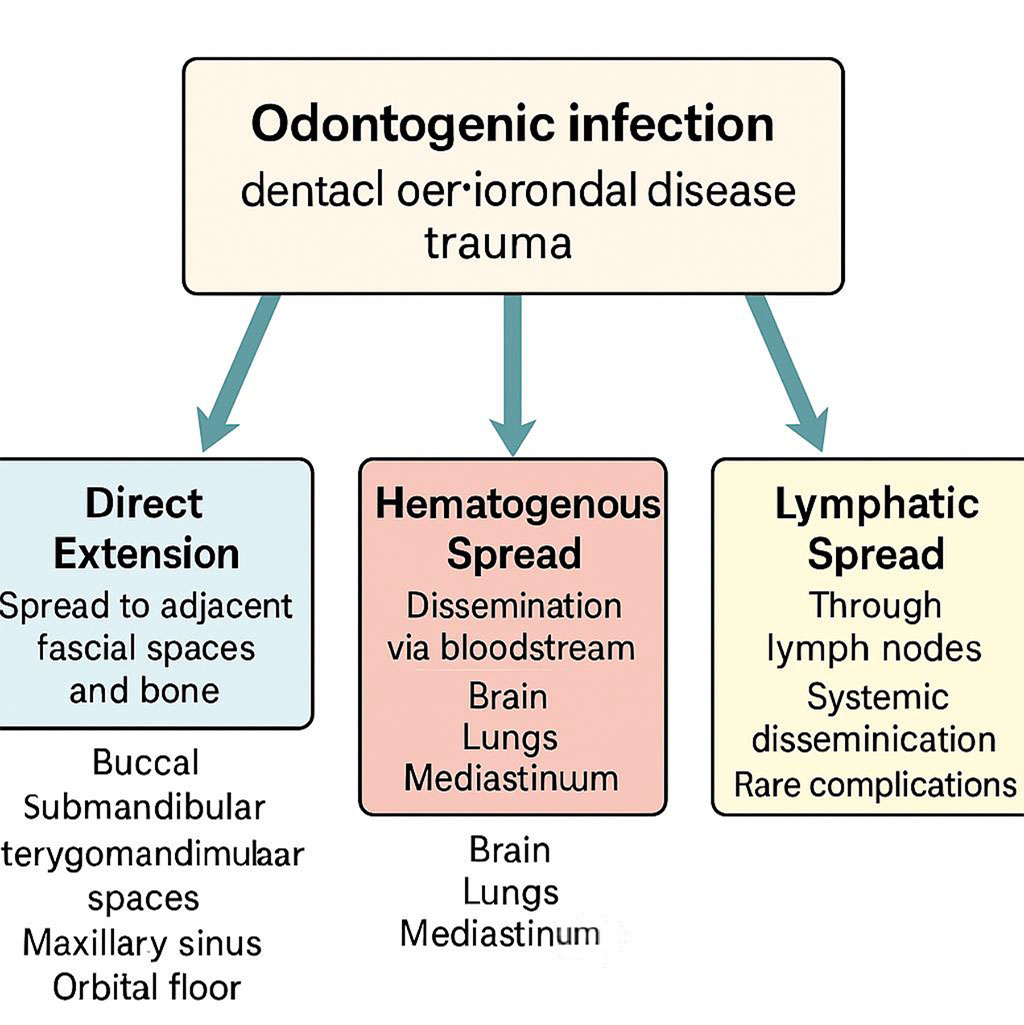 Figure 3. Pathways of Spread of Odontogenic Infections